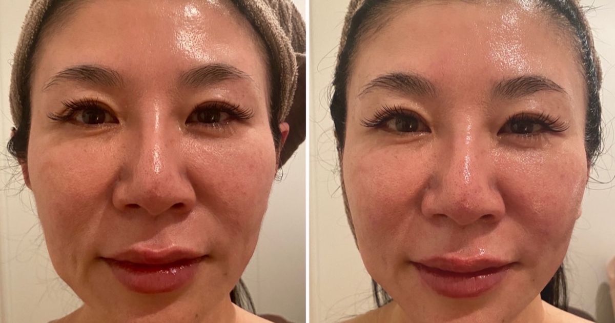 すずりん サーマルフラクショナル フラクショナルRF サーマルフラクショナルRF - Renon Ciel